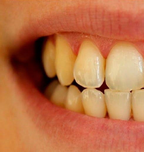 Чистка зубов ультразвуком. Фото до