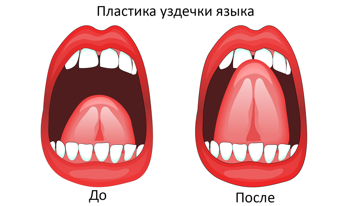 пластика уздечки языка до и после