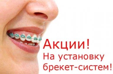 АКЦИЯ на керамический брекет-системы АКЦИЯ на керамический брекет-системы