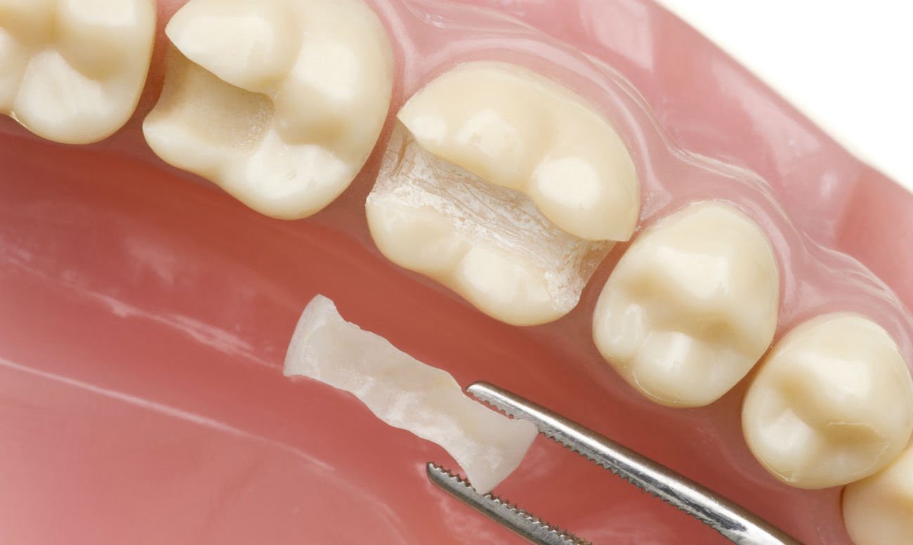 Пломбирование и реставрация зубов в Брянске