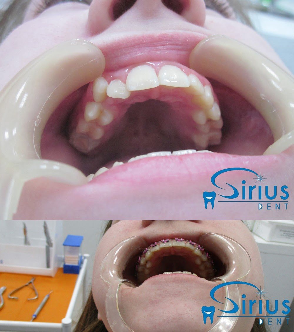 сужение верхнего и нижнего зубного ряда