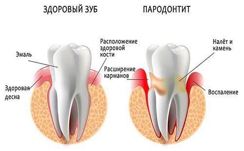 Чем опасны зубные отложения