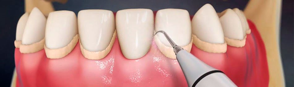 Очищение зубов в стоматологии