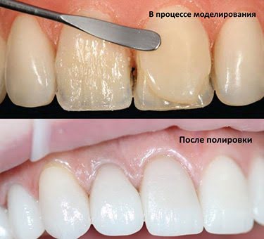 Прямая реставрация зубов