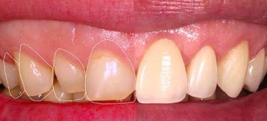 Результаты наращивания зубов