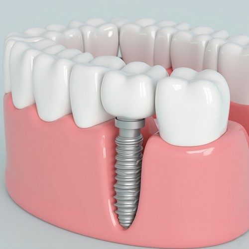Как выбрать врача-имплантолога и не ошибиться