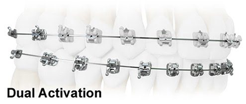 Обычные и самолигирующие брекеты - в чём разница? Обычные и самолигирующие брекеты - в чём разница?