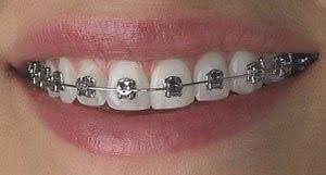 Обычные и самолигирующие брекеты - в чём разница? Обычные и самолигирующие брекеты - в чём разница?